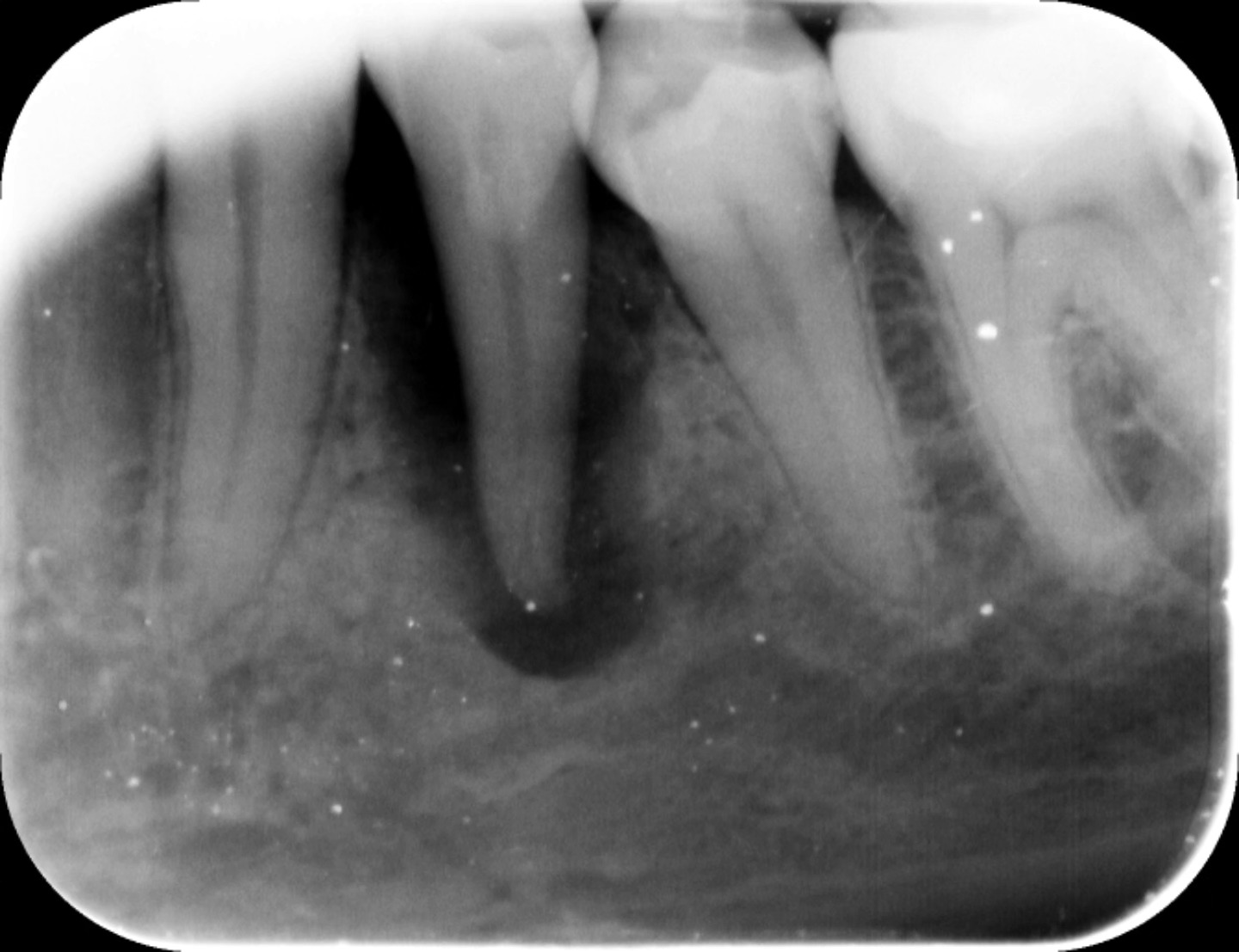 You get a tooth like this and the patient is completely asymptomatic. No isol...